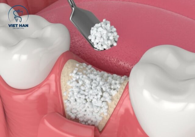 Ghép xương implant giúp tái tạo nền xương hàm trước khi cấy trụ Implant