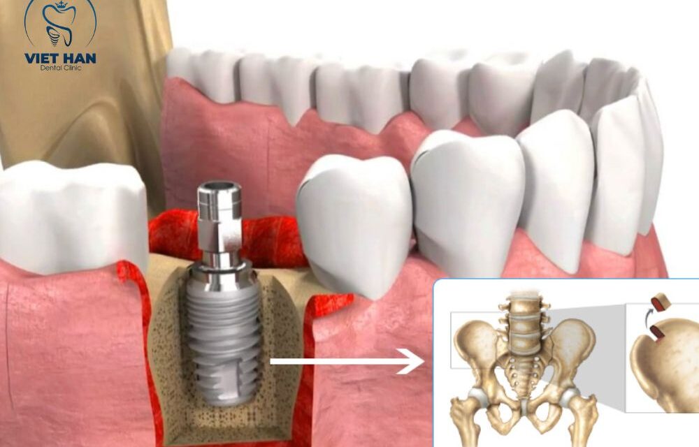 Ghép xương Implant là gì? Khi nào cần thực hiện?