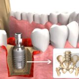 Trường hợp cần ghép xương implant khi xương hàm bị tiêu nhiều
