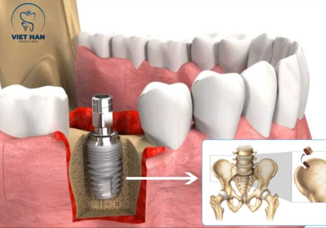 Trường hợp cần ghép xương implant khi xương hàm bị tiêu nhiều