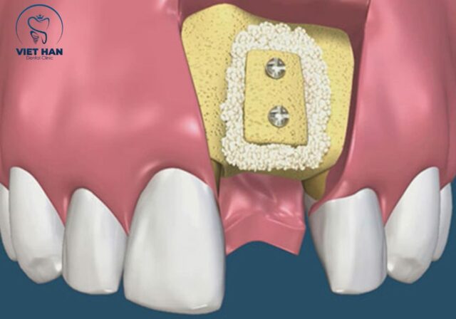 Ghép xương implant giúp tăng độ ổn định và tỷ lệ thành công khi trồng răng