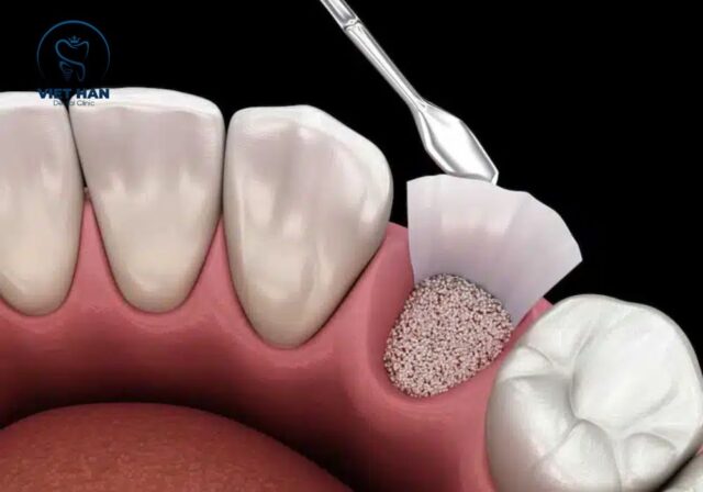 Ghép xương implant được thực hiện nhẹ nhàng với gây tê phù hợp