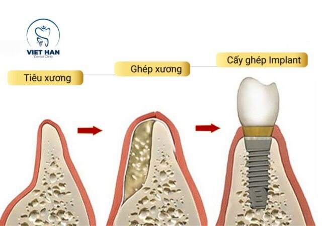 Thời gian lành thương sau ghép xương implant thường từ 2 – 6 tháng