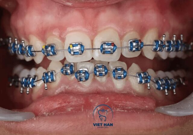 Mắc cài kim loại thường phù hợp với nhiều người nhờ hiệu quả chỉnh nha ổn định.