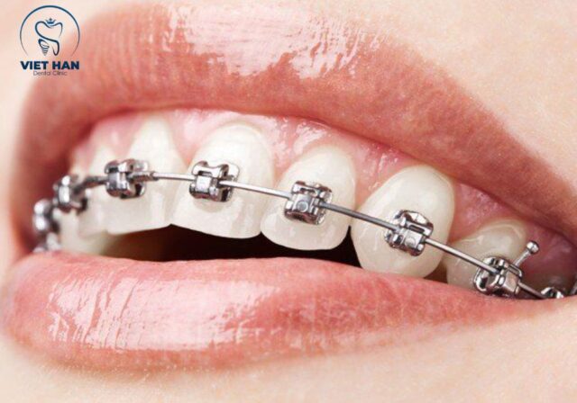 Mắc cài kim loại tự động giúp giảm ma sát và hỗ trợ răng dịch chuyển tốt hơn.