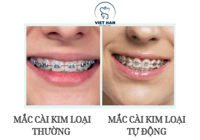 Mắc cài kim loại thường và tự động có khác biệt về lực kéo và cảm giác đeo.