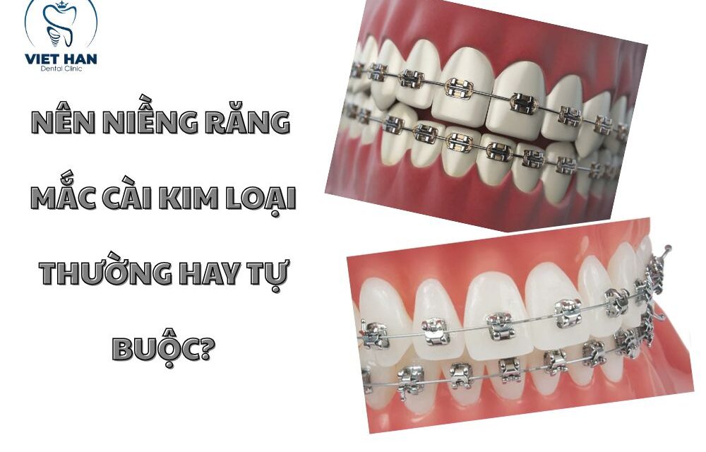 Nên niềng răng mắc cài kim loại thường hay tự động?