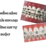 Chọn mắc cài kim loại phù hợp sẽ giúp quá trình niềng thoải mái và hiệu quả hơn.