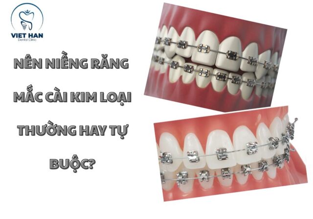 Chọn mắc cài kim loại phù hợp sẽ giúp quá trình niềng thoải mái và hiệu quả hơn.
