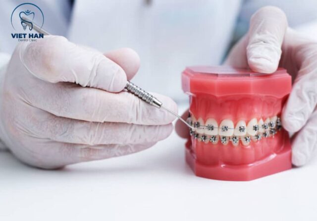 Vệ sinh đúng cách giúp mắc cài kim loại hạn chế bung sút và bám thức ăn.