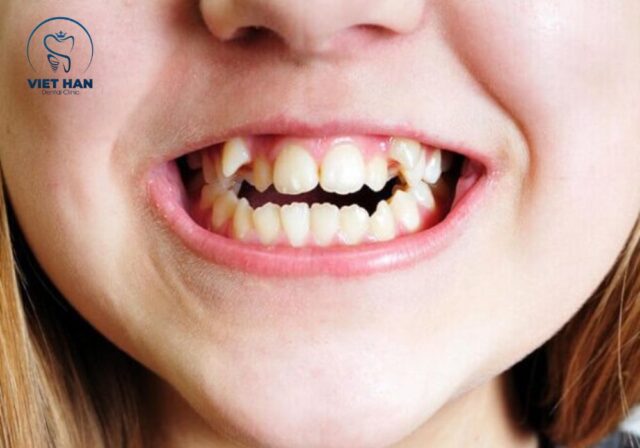 Răng khểnh là gì? Tìm hiểu đặc điểm và nguyên nhân răng khểnh thường gặp.