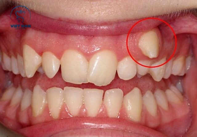Răng khểnh có thể gây khó vệ sinh, lệch khớp cắn và ảnh hưởng thẩm mỹ.