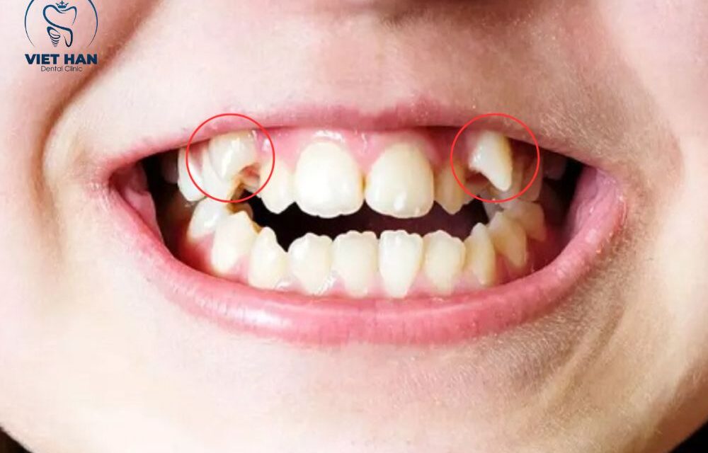 Răng khểnh có tốt không? Nên niềng hay nên giữ?