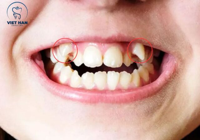 Răng khểnh mọc lệch nhiều thường được bác sĩ khuyên chỉnh nha sớm.