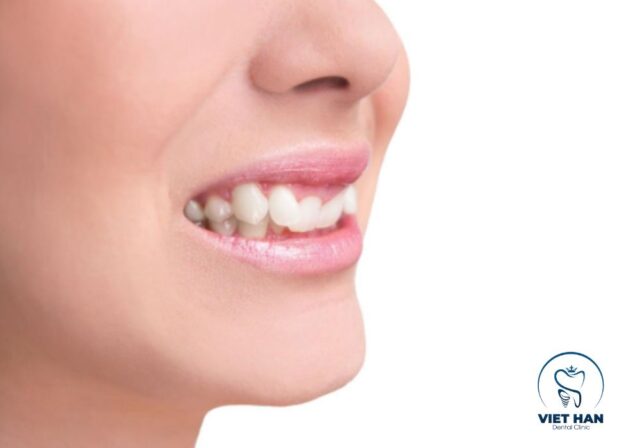 Không phải trường hợp răng khểnh nào cũng cần niềng hoặc can thiệp.
