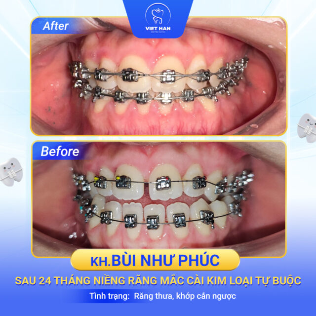Niềng răng thưa giúp răng đều đẹp hơn, hạn chế giắt thức ăn và bệnh lý răng miệng.