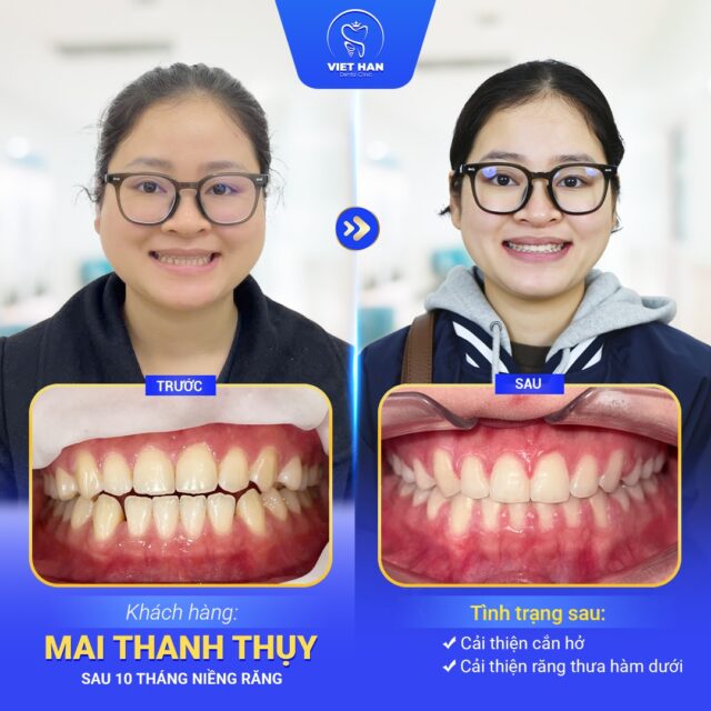 Niềng răng thưa có thể ê nhẹ vài ngày đầu do răng bắt đầu dịch chuyển.