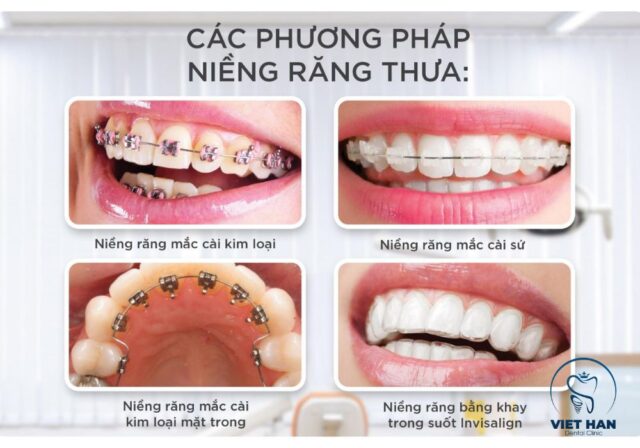Các phương pháp niềng răng thưa phổ biến hiện nay phù hợp nhiều nhu cầu thẩm mỹ và chi phí.