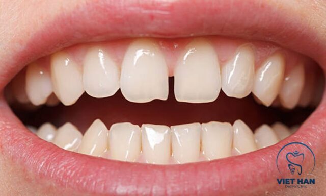 Niềng răng thưa có cần nhổ răng tùy vào khoảng trống và tình trạng cung hàm.