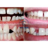 Niềng răng thưa giúp kéo khít kẽ răng, cải thiện thẩm mỹ và ăn nhai hiệu quả.