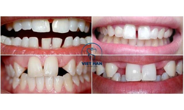 Niềng răng thưa giúp kéo khít kẽ răng, cải thiện thẩm mỹ và ăn nhai hiệu quả.