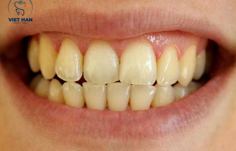 Răng Vàng Do Đâu? Cách Cải Thiện Hiệu Quả Và An Toàn ?