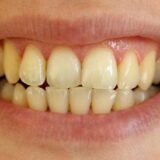 Răng vàng khiến nhiều người mất tự tin khi cười và giao tiếp hằng ngày.