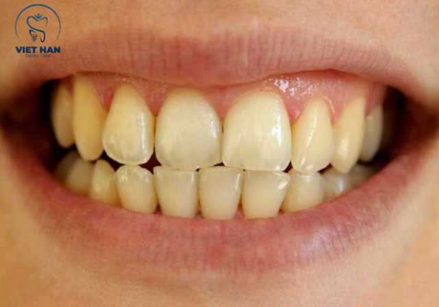 Răng vàng khiến nhiều người mất tự tin khi cười và giao tiếp hằng ngày.