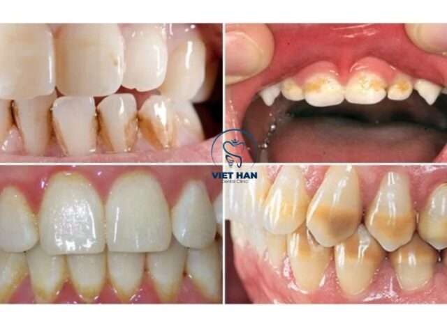 Thói quen ăn uống và vệ sinh kém là nguyên nhân phổ biến gây răng vàng.