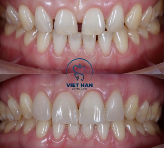 Trám răng thẩm mỹ cho răng sâu, răng thưa nhẹ an toàn và nhanh chóng.
