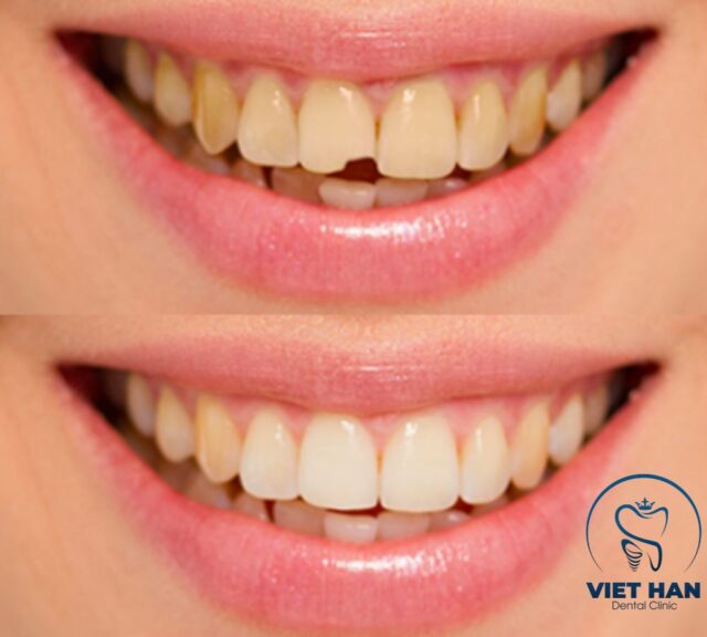 Trám răng thẩm mỹ giúp phục hồi răng sâu, mẻ và cải thiện nụ cười tự nhiên.