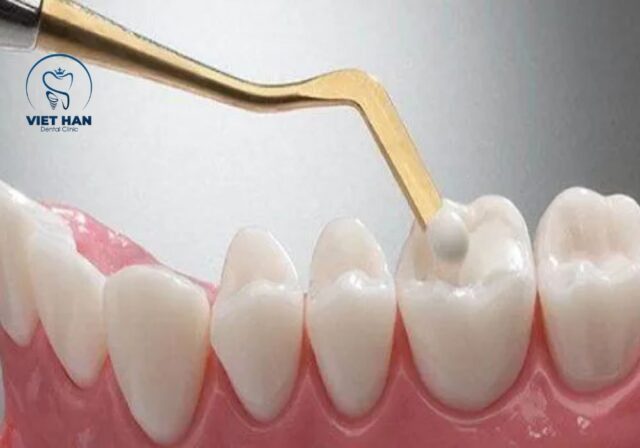 Lợi ích của trám răng thẩm mỹ giúp tăng thẩm mỹ và hỗ trợ ăn nhai tốt hơn.