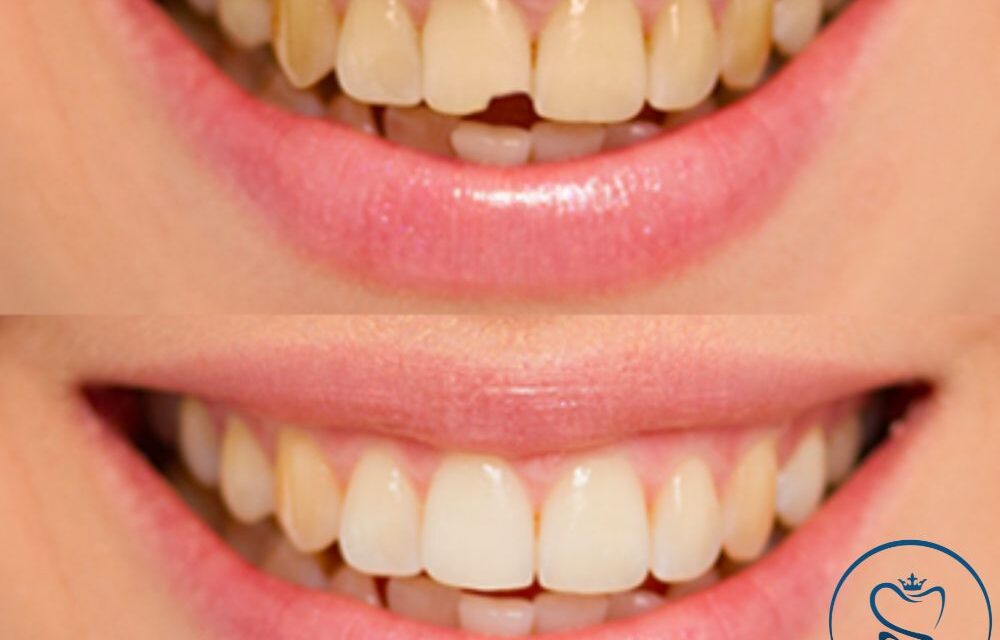 Trám răng thẩm mỹ: Giải pháp phục hồi răng đẹp