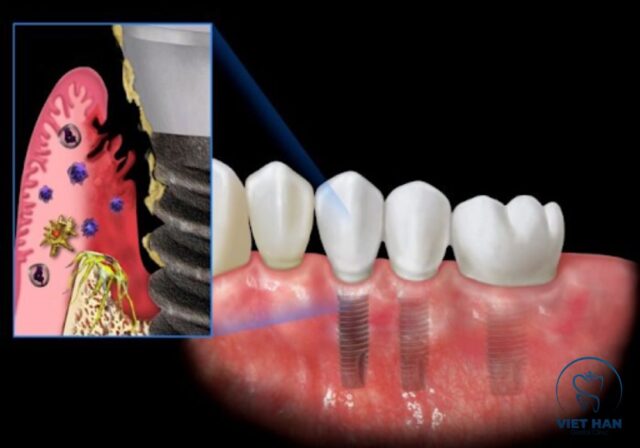 Sau khi cắm implant có thể ê nhẹ vài ngày đầu và giảm dần theo thời gian.