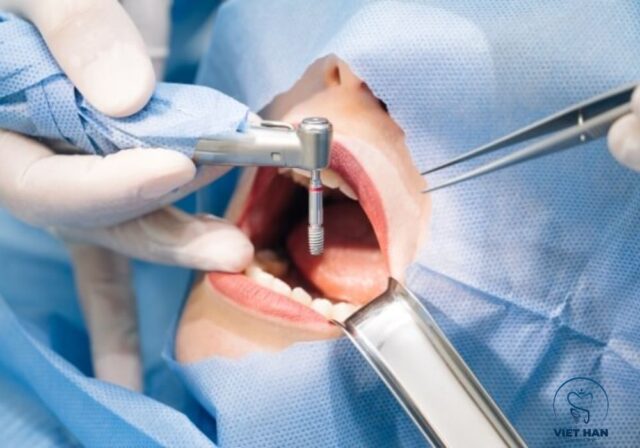 Tay nghề bác sĩ và công nghệ hiện đại giúp giảm đau khi cắm implant.
