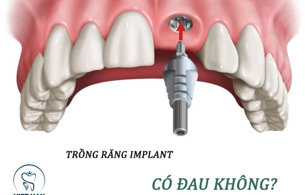 Cắm Implant có gây đau đớn không? Cách giảm đau hiệu quả