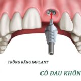 Chăm sóc đúng cách sau cắm implant giúp giảm đau và hồi phục nhanh hơn.