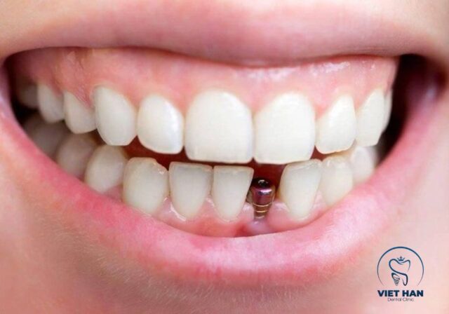 Cắm implant là giải pháp phục hồi răng mất an toàn, thẩm mỹ và ít đau.