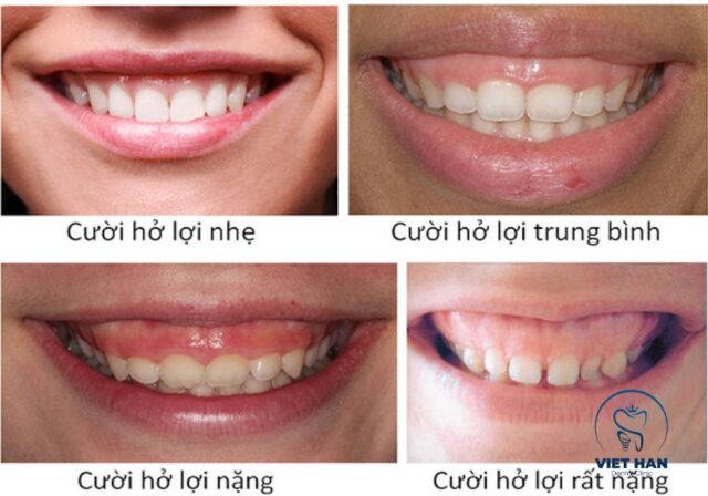 Cười hở lợi là tình trạng nướu lộ ra quá nhiều khi cười, ảnh hưởng đến thẩm mỹ nụ cười.