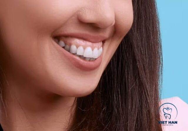 Cười hở lợi có thể xuất phát từ nướu, răng, môi hoặc xương hàm.
