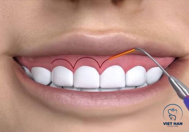 Cắt nướu thẩm mỹ giúp thân răng lộ rõ hơn và giảm tình trạng cười hở lợi.