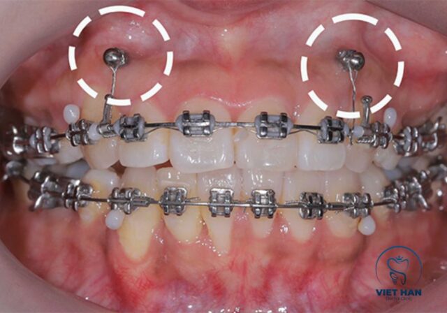 Niềng răng giúp cải thiện cười hở lợi do hô răng hoặc sai lệch khớp cắn.