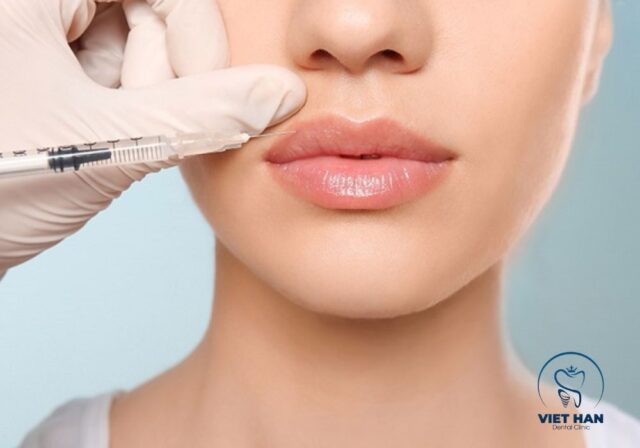 Tiêm Botox giúp giảm hoạt động cơ nâng môi và hạn chế cười hở lợi.