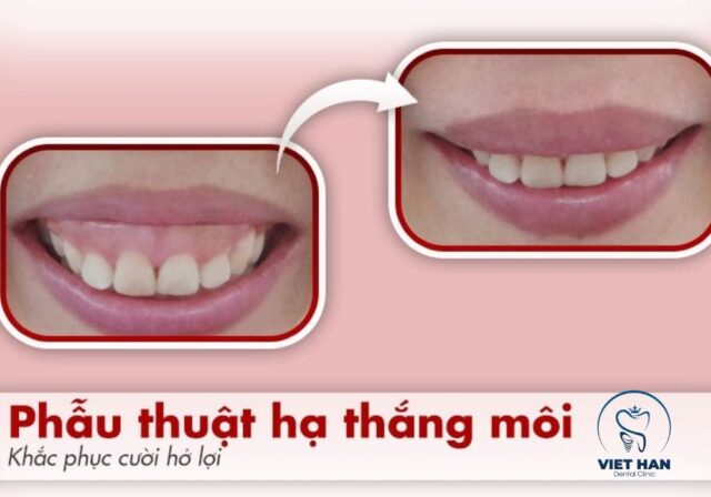 Phẫu thuật hạ môi trên giúp che phủ nướu hiệu quả hơn khi cười.