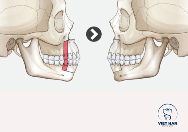 Phẫu thuật xương hàm là giải pháp cho các trường hợp cười hở lợi nặng.