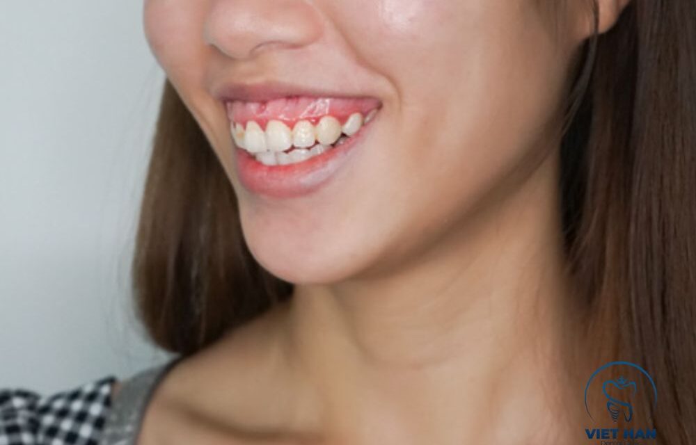 Cười Hở Lợi: Các Phương Pháp Điều Trị Hiệu Quả Và An Toàn