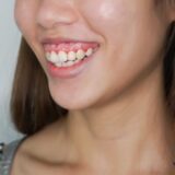 Lựa chọn phương pháp điều trị cười hở lợi phụ thuộc vào nguyên nhân cụ thể.