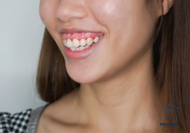 Lựa chọn phương pháp điều trị cười hở lợi phụ thuộc vào nguyên nhân cụ thể.