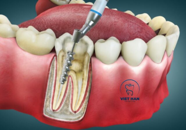 Lấy tủy răng giúp loại bỏ phần tủy viêm nhiễm và bảo tồn răng thật.