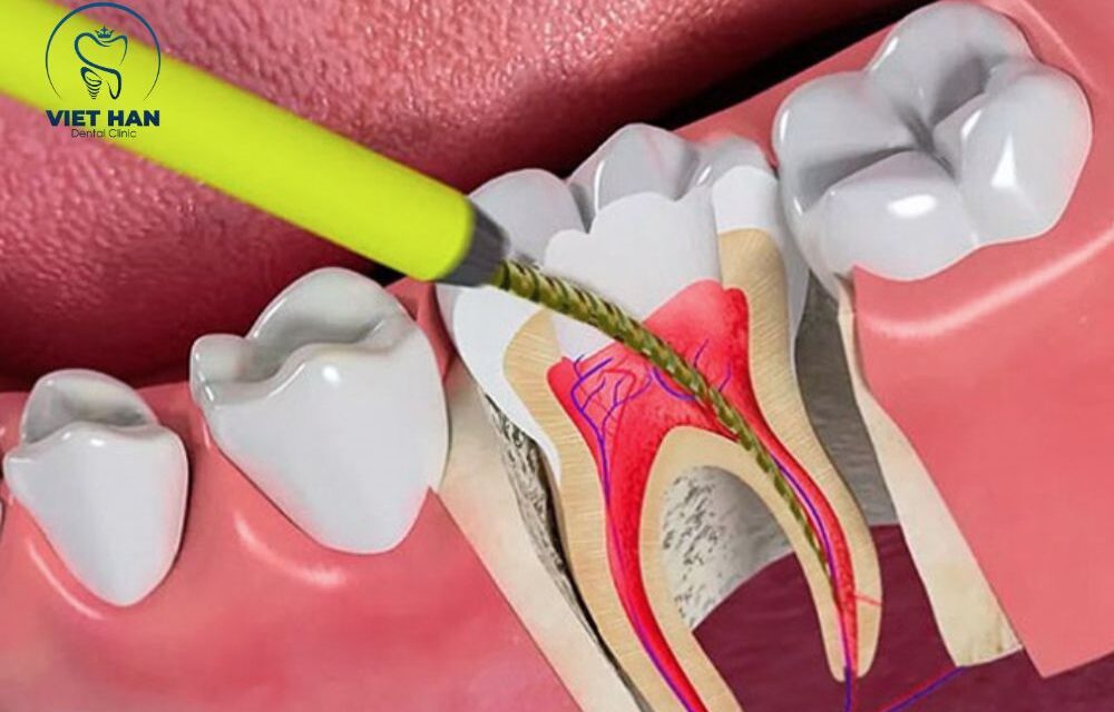 Lấy Tủy Răng Có Đau Không? Những Điều Cần Biết Khi Điều Trị